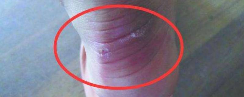 鞋子打脚怎么办小妙招